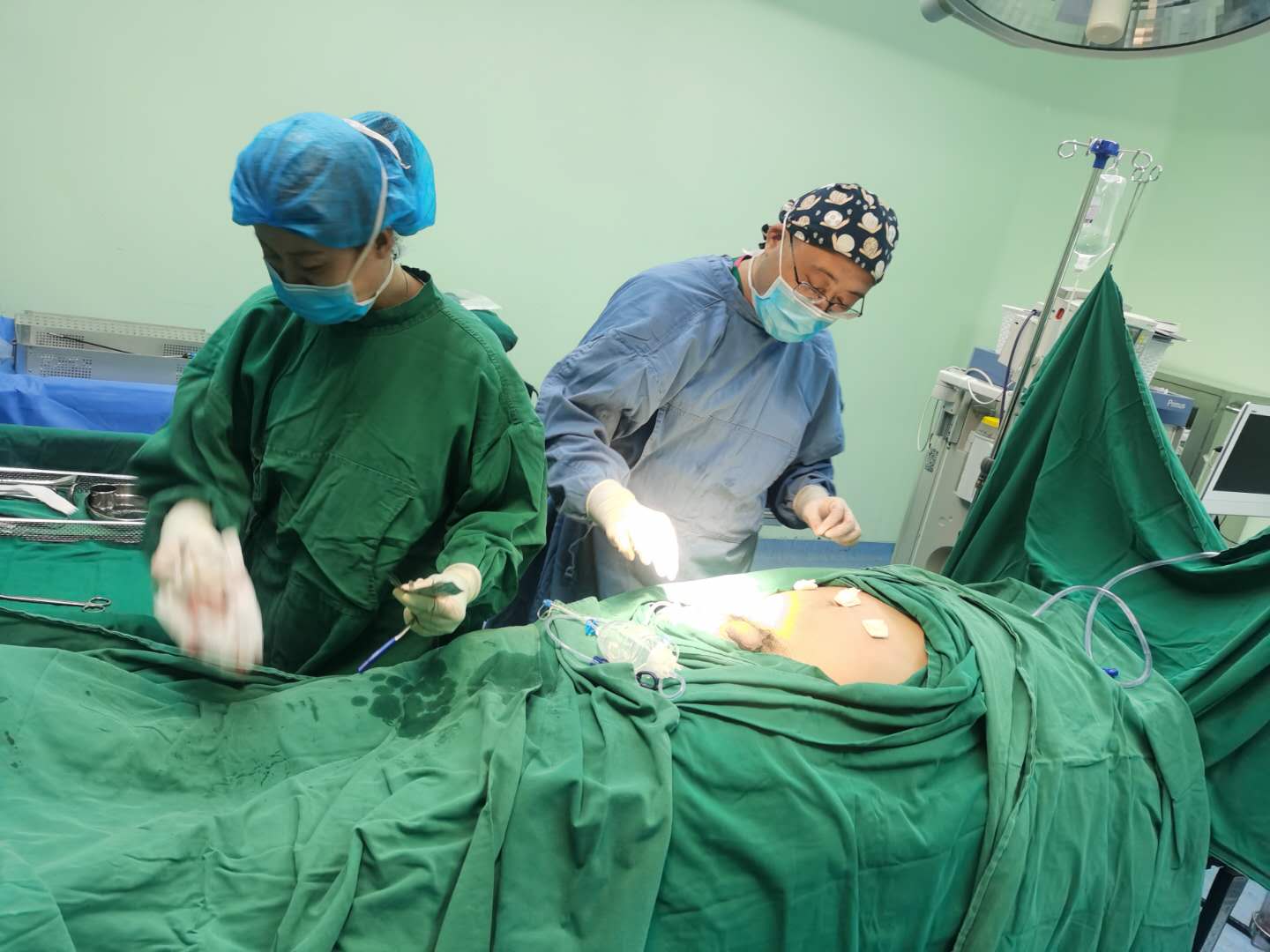 乌拉特前旗人民医院普外科成功为一例巨大腹股沟斜疝患者实施杂交手术